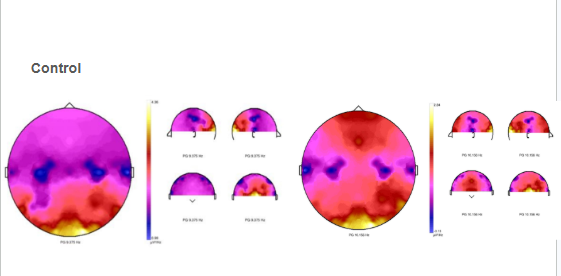 Análisis de Densidad Espectral de Potencia PSD - Comparativa Control vs Paciente
